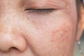 Hyperpigmentation Treatment